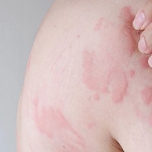 Hives (Urticaria) Alert: Causes, Symptoms & Prevention Tips You Should Know