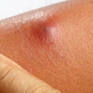 Boils: Causes, Symptoms, and Treatment