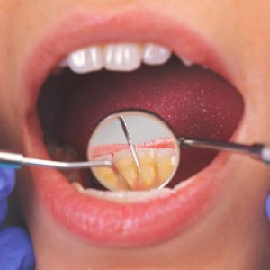 Screen addiction and tooth decay – Important things to know!!