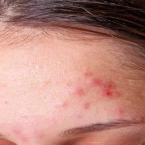 Pimples on various parts of our body – Important things to know!!